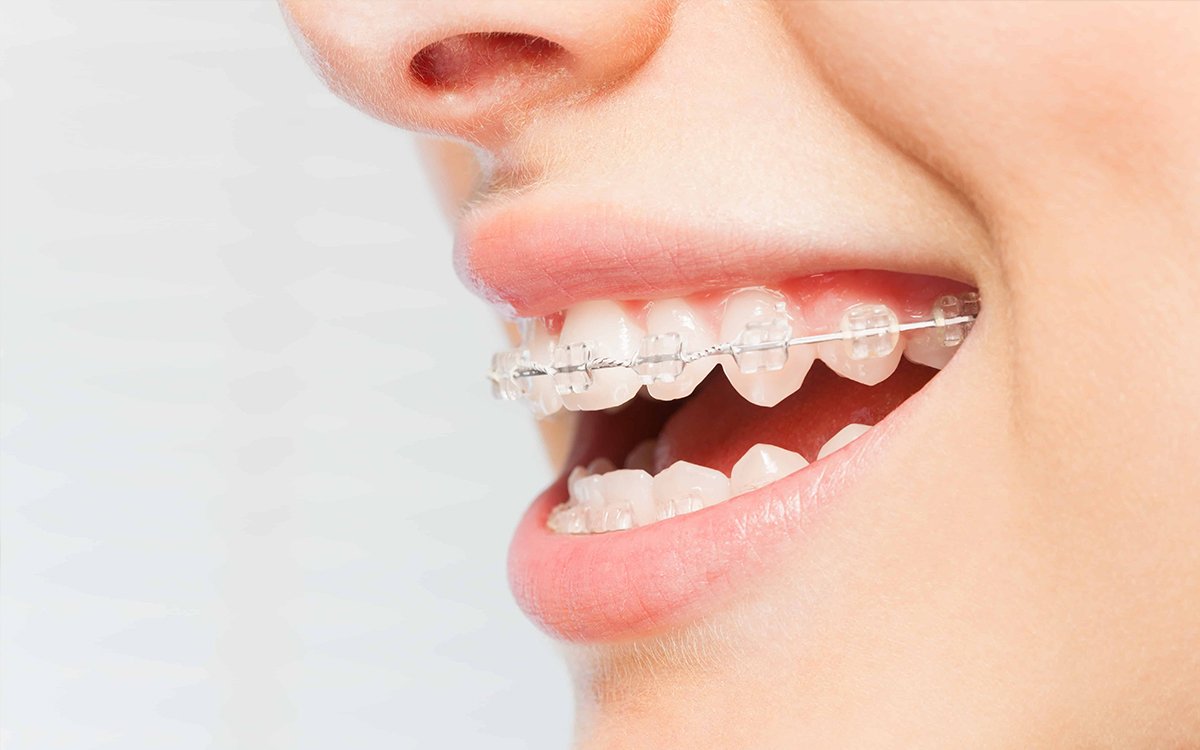 Clear Braces in Vaughan