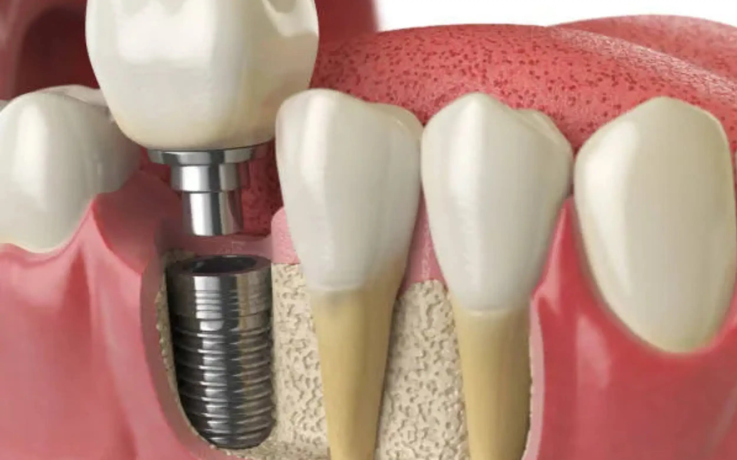 Dental Implants in Vaughan