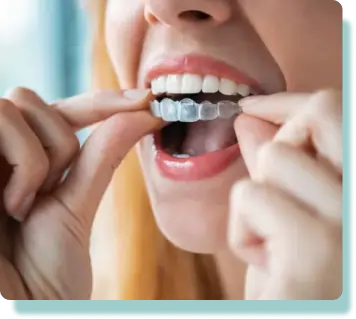 Clear Aligners