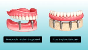 Types of Upper Denture Implant