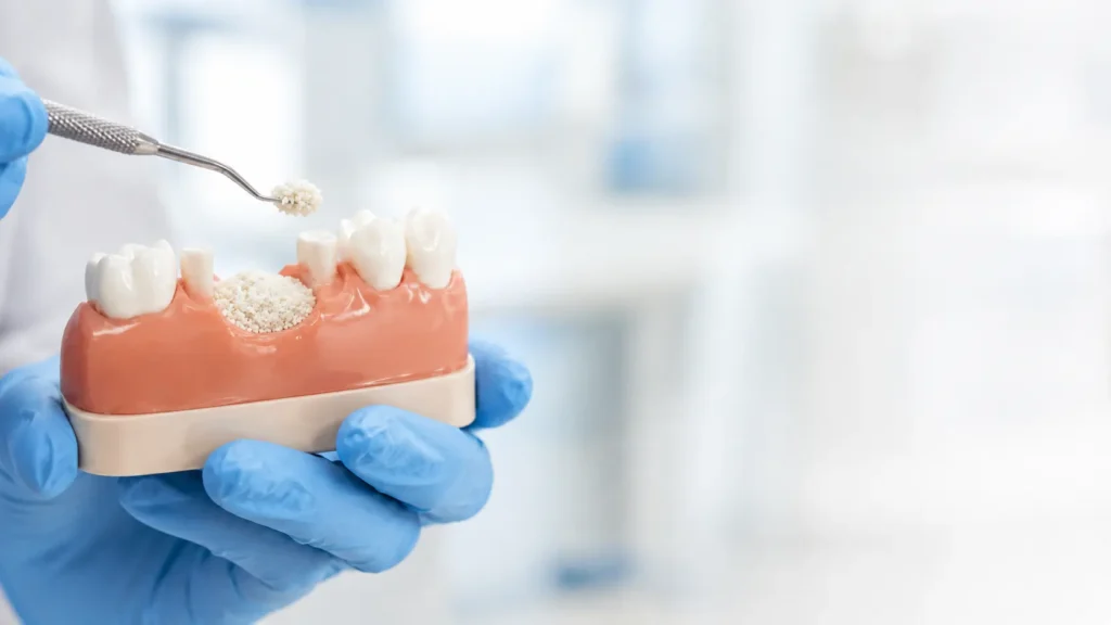 Bone Grafting