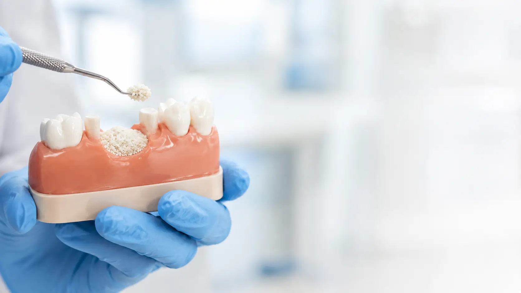 Bone Grafting