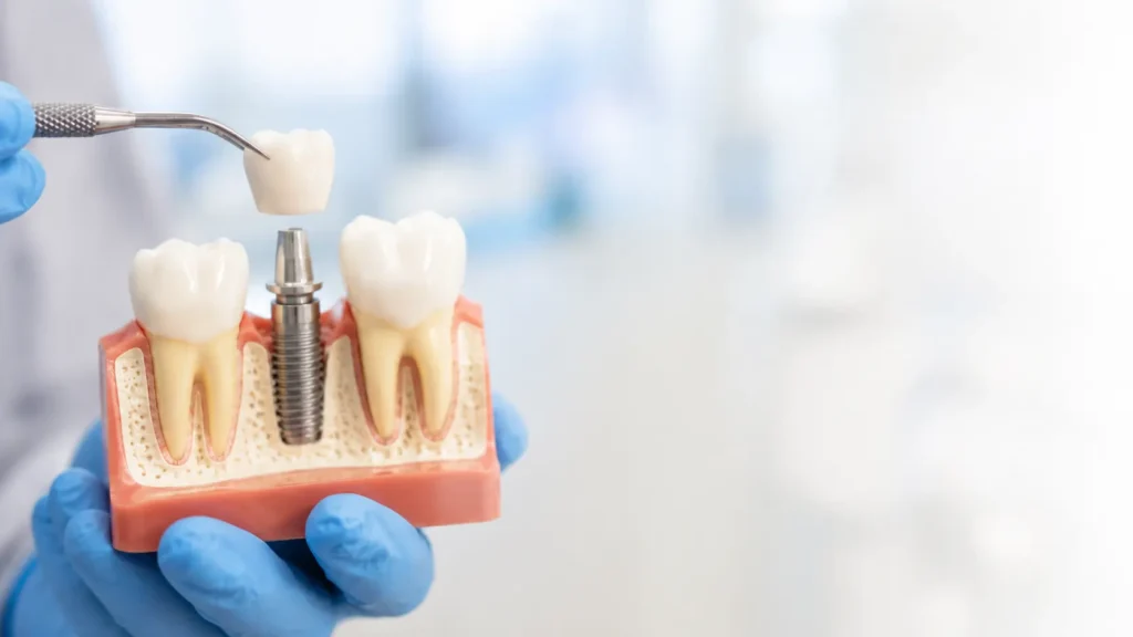 Dental Implants