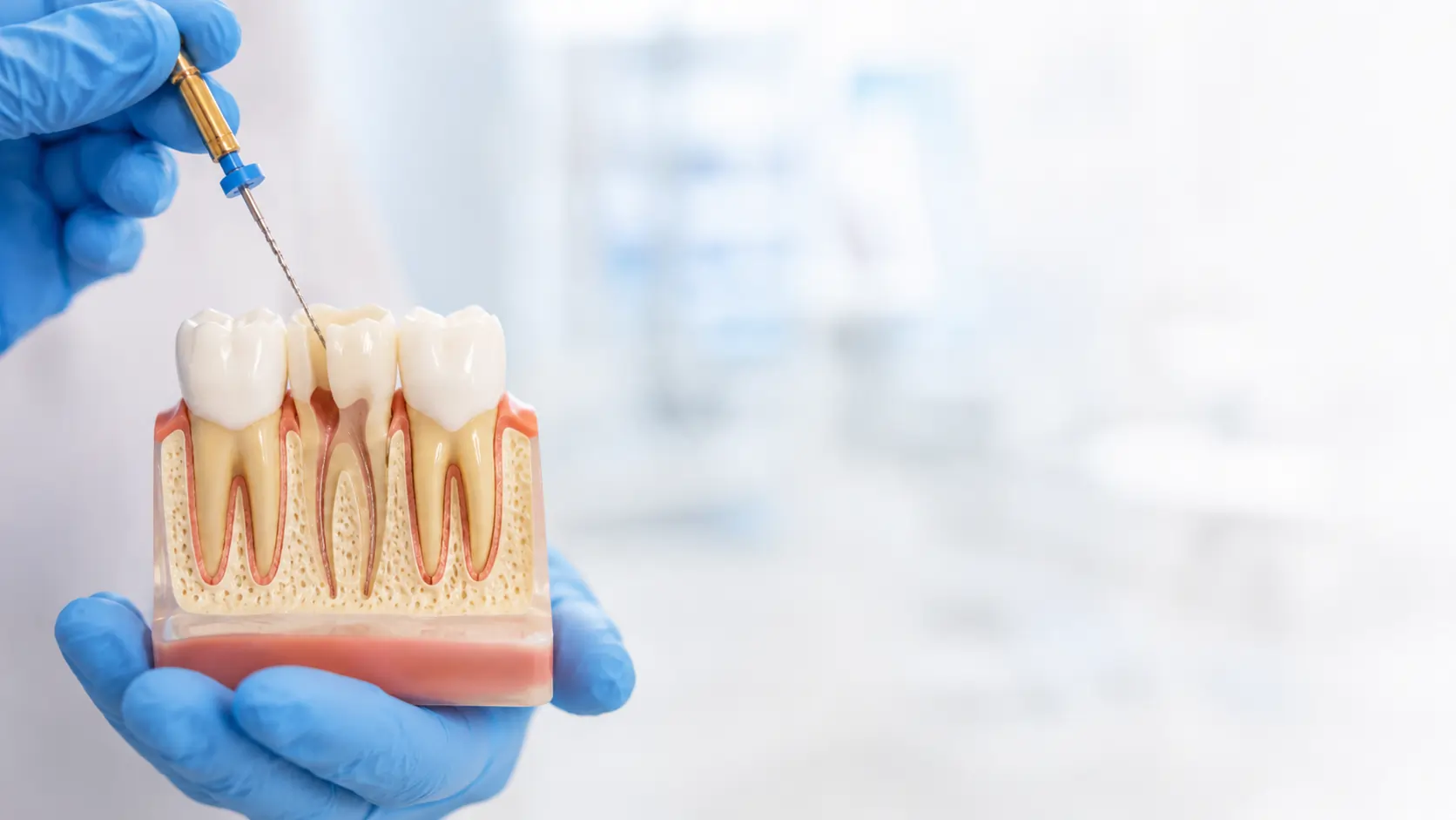Root Canal Therapy