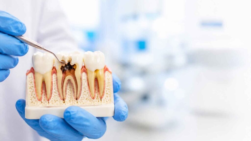 Tooth Decay