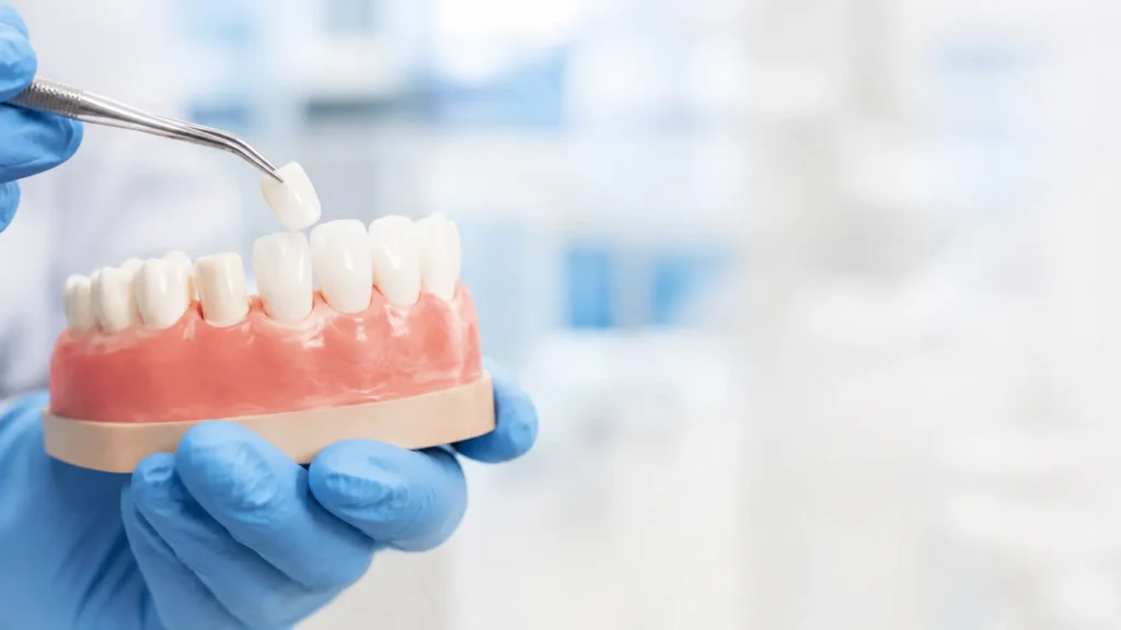 Veneers