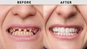 Dental Crown Before and After